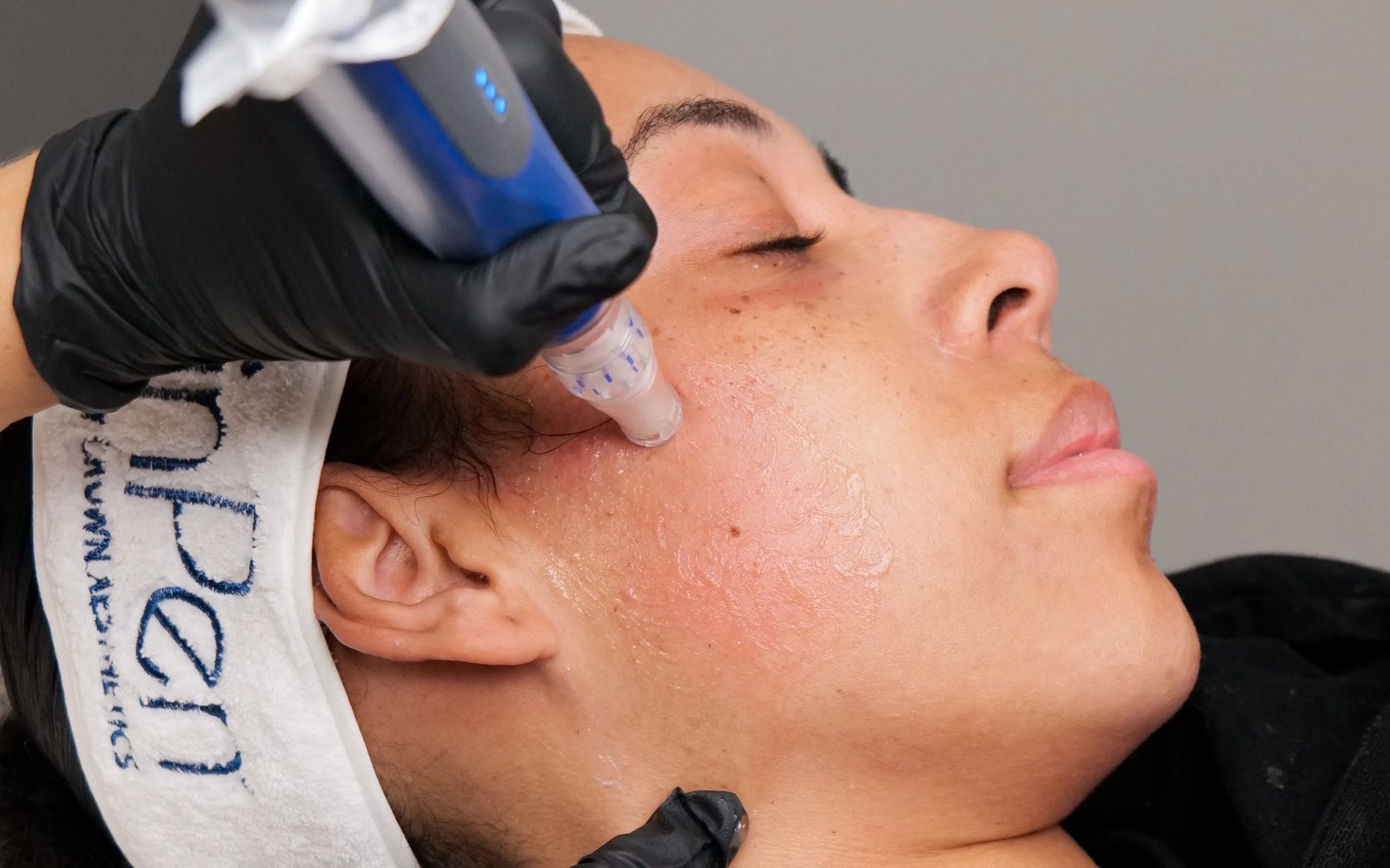 Microneedling being performed on a client's cheek
