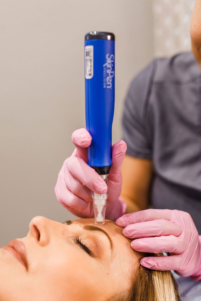 Microneedling device in use