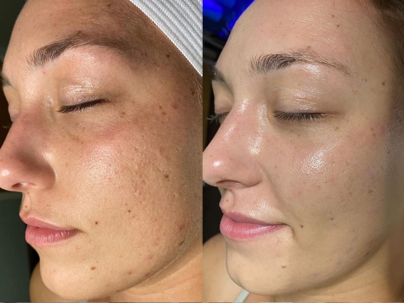 Before and after showing reduced congestion and smoother texture