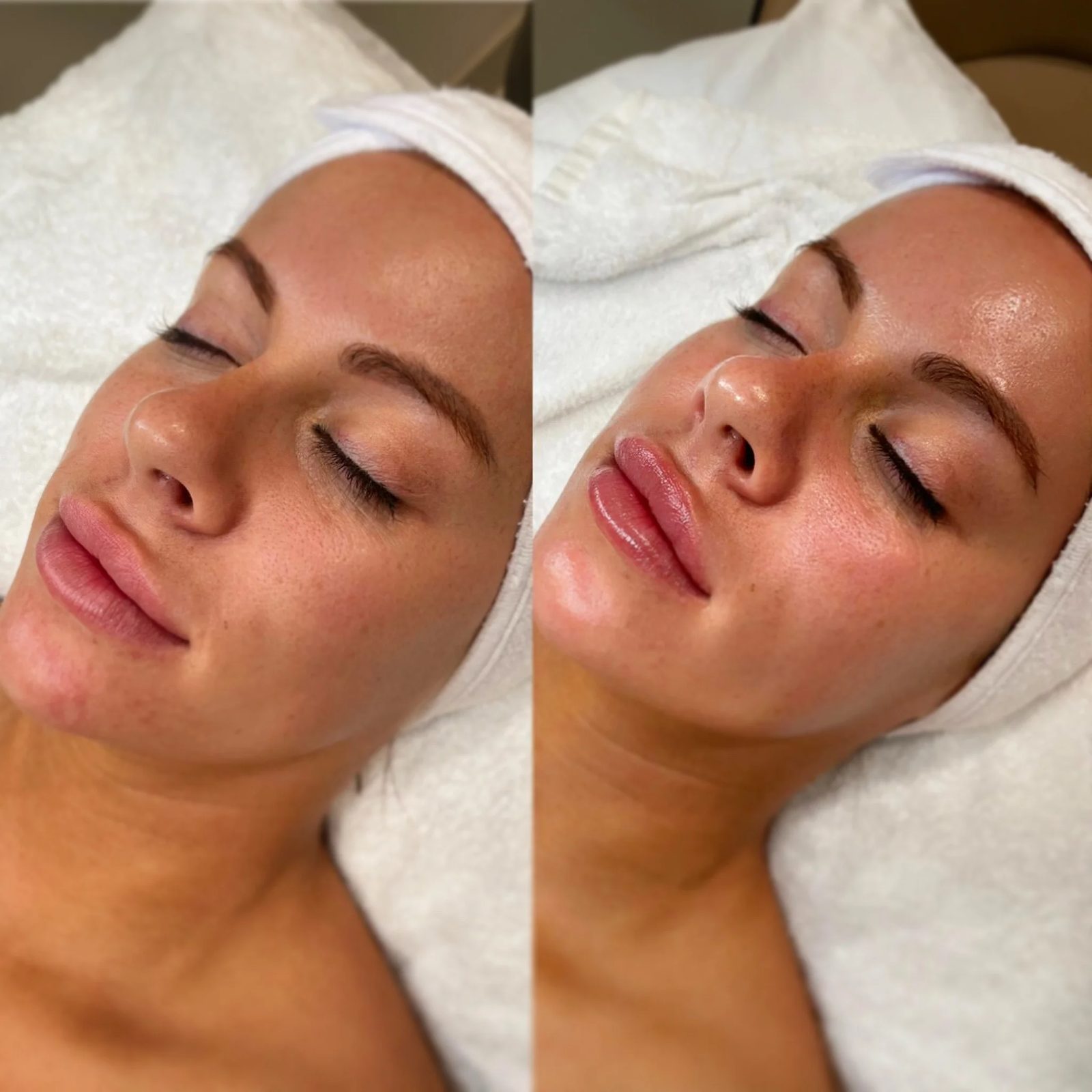 Before and after a facial showing brighter smoother skin