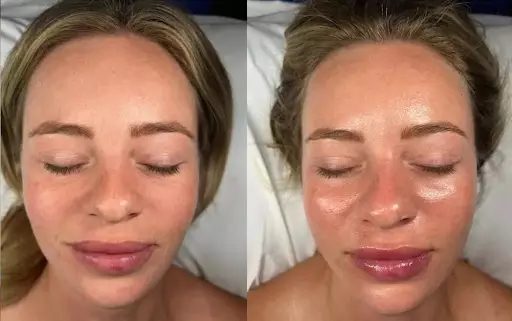 Before and after a Hydrofacial