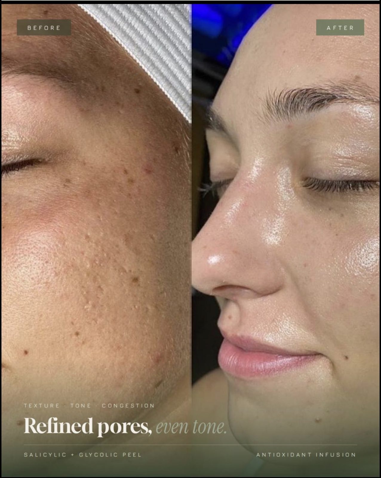 Before and after a chemical peel showing refined pores and even tone