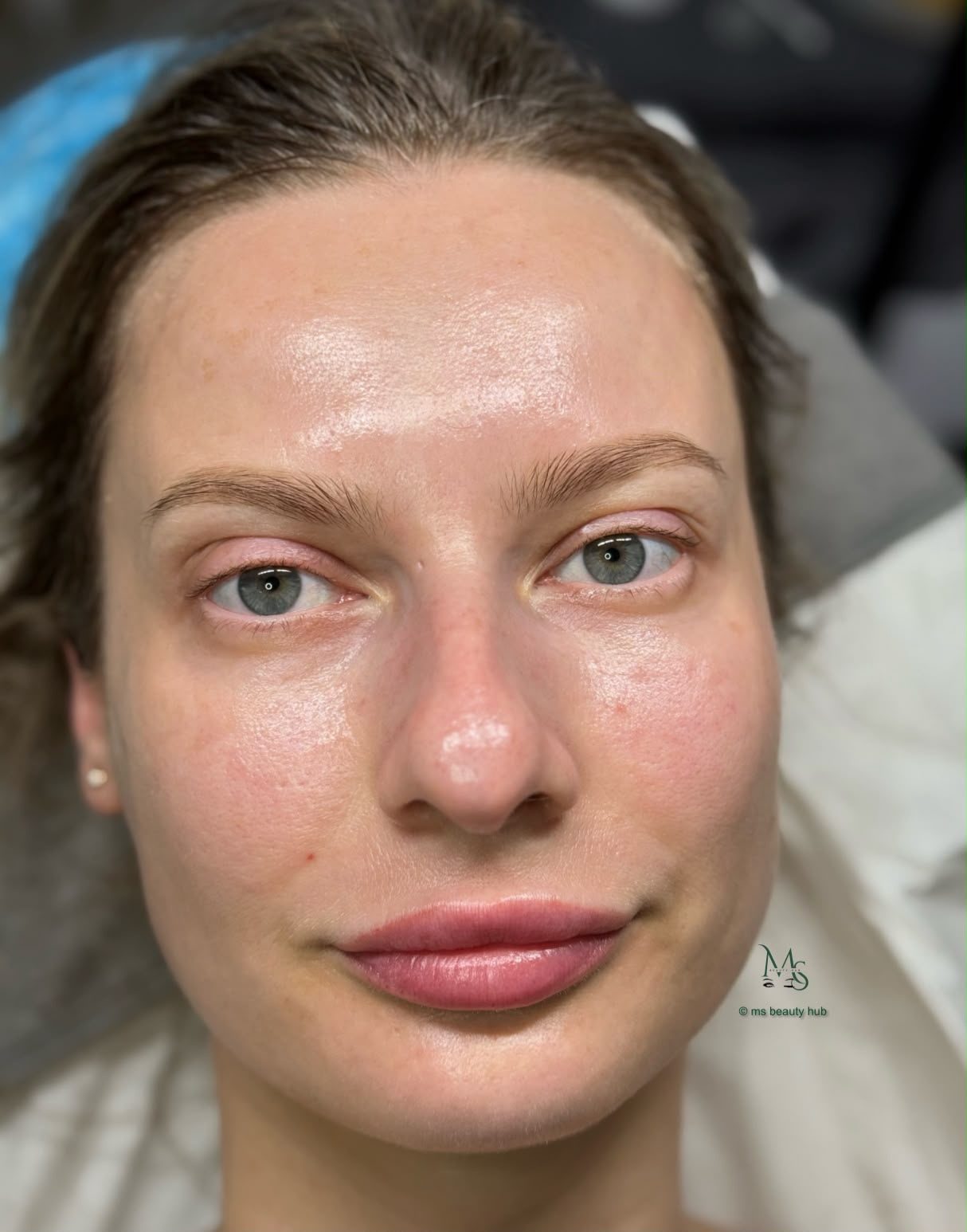 A client's skin after completing a bespoke facial treatment plan