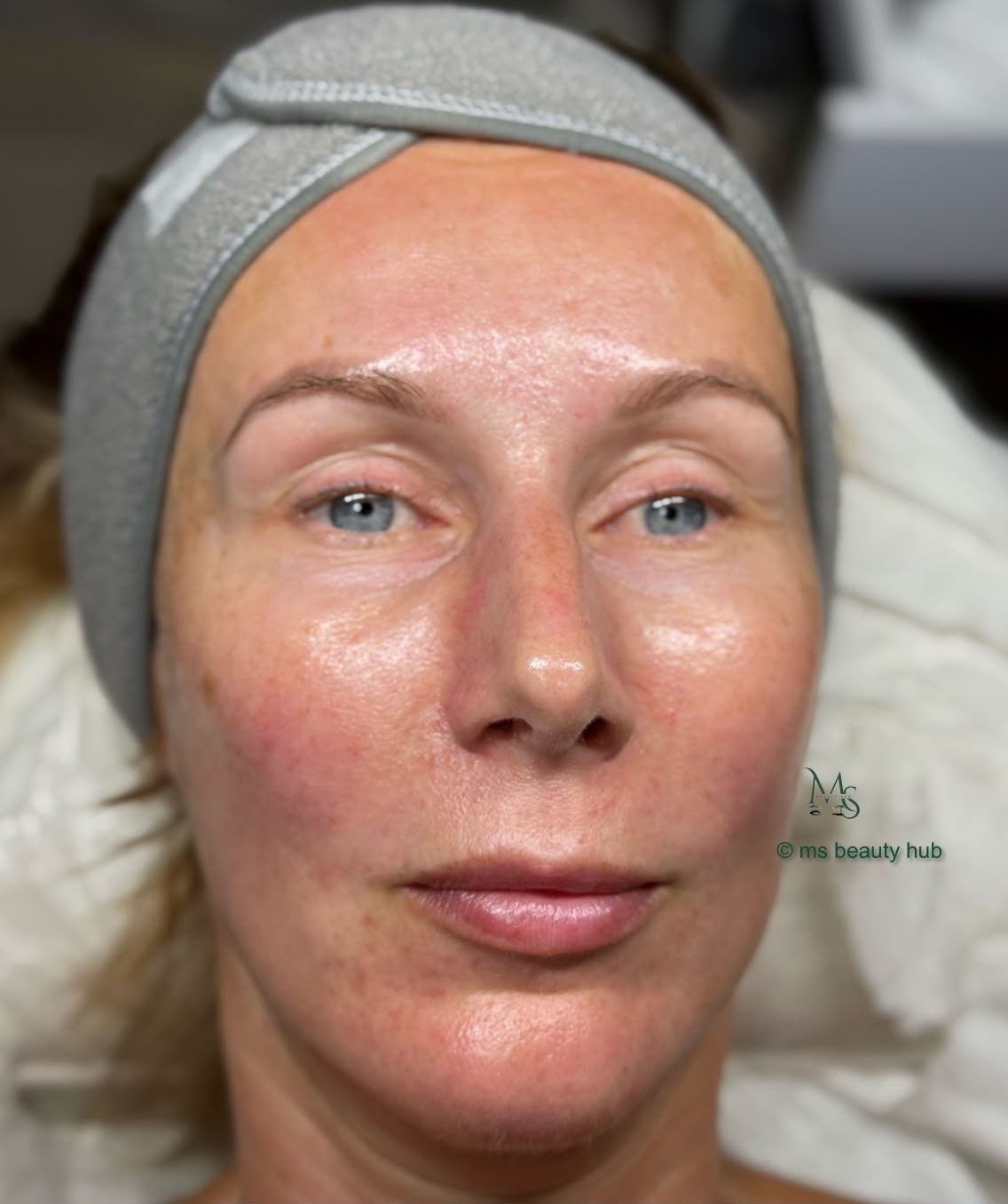 A client's skin after completing a bespoke facial treatment plan